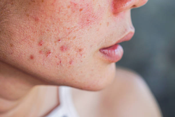 Expert Tips for Fighting Acne and Breakouts