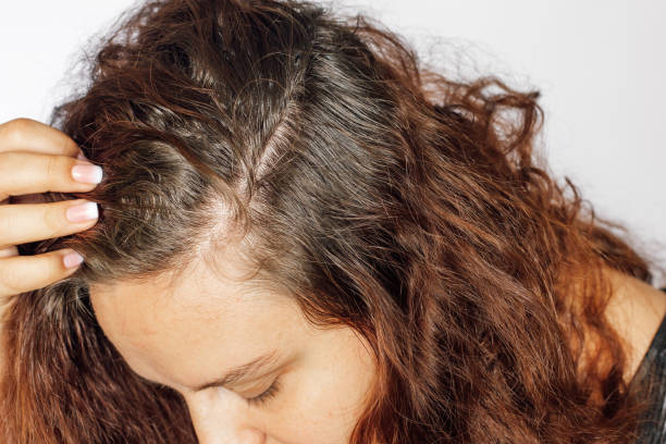 The Importance of Scalp Exfoliation for Oily Hair